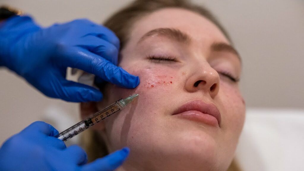 Collagen