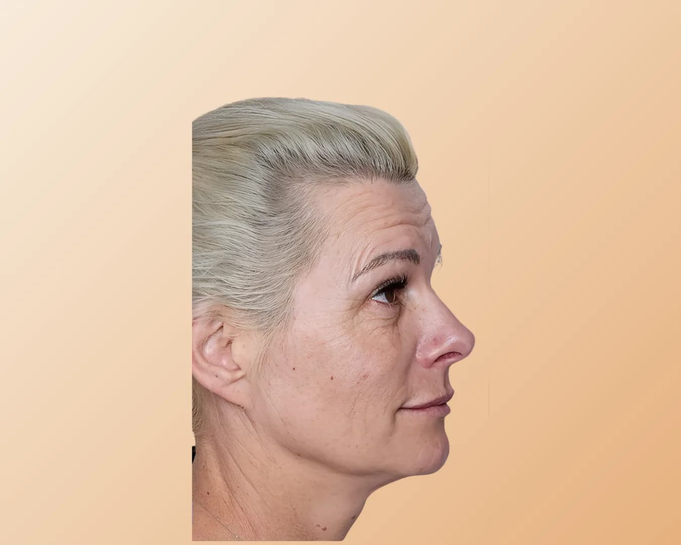 A woman with pale blonde hair photographed in side profile before treatment, with horizontal lines across the forehead and fine lines around the eye