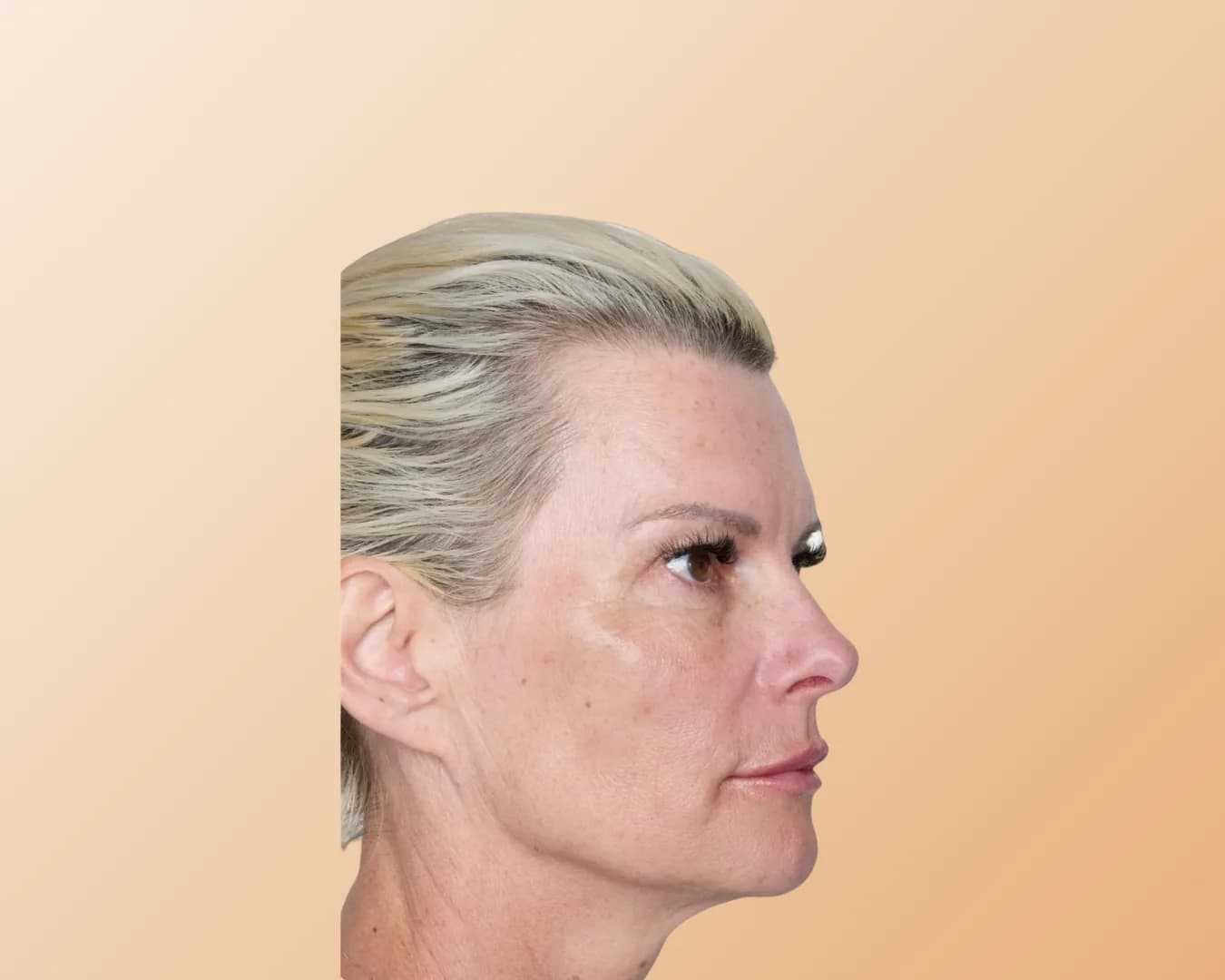 The same woman in the same side profile after treatment, with the forehead and the skin around the eye looking smoother