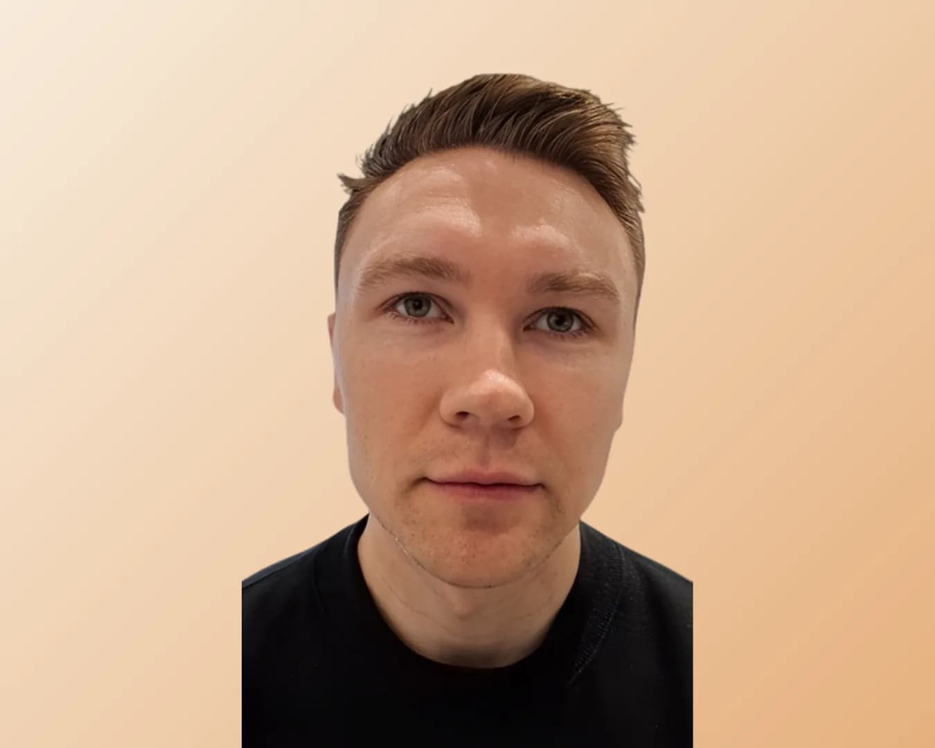 The same man in the same face-on portrait after treatment, with a more clearly defined jawline and chin
