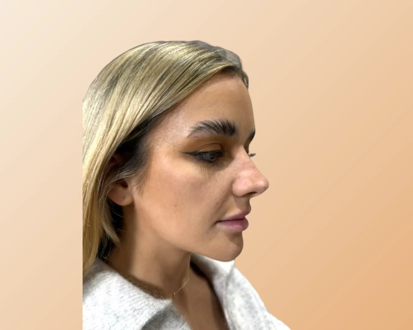 A blonde woman photographed in three-quarter view before treatment, with shadowing and hollowing beneath the eye and across the upper cheek
