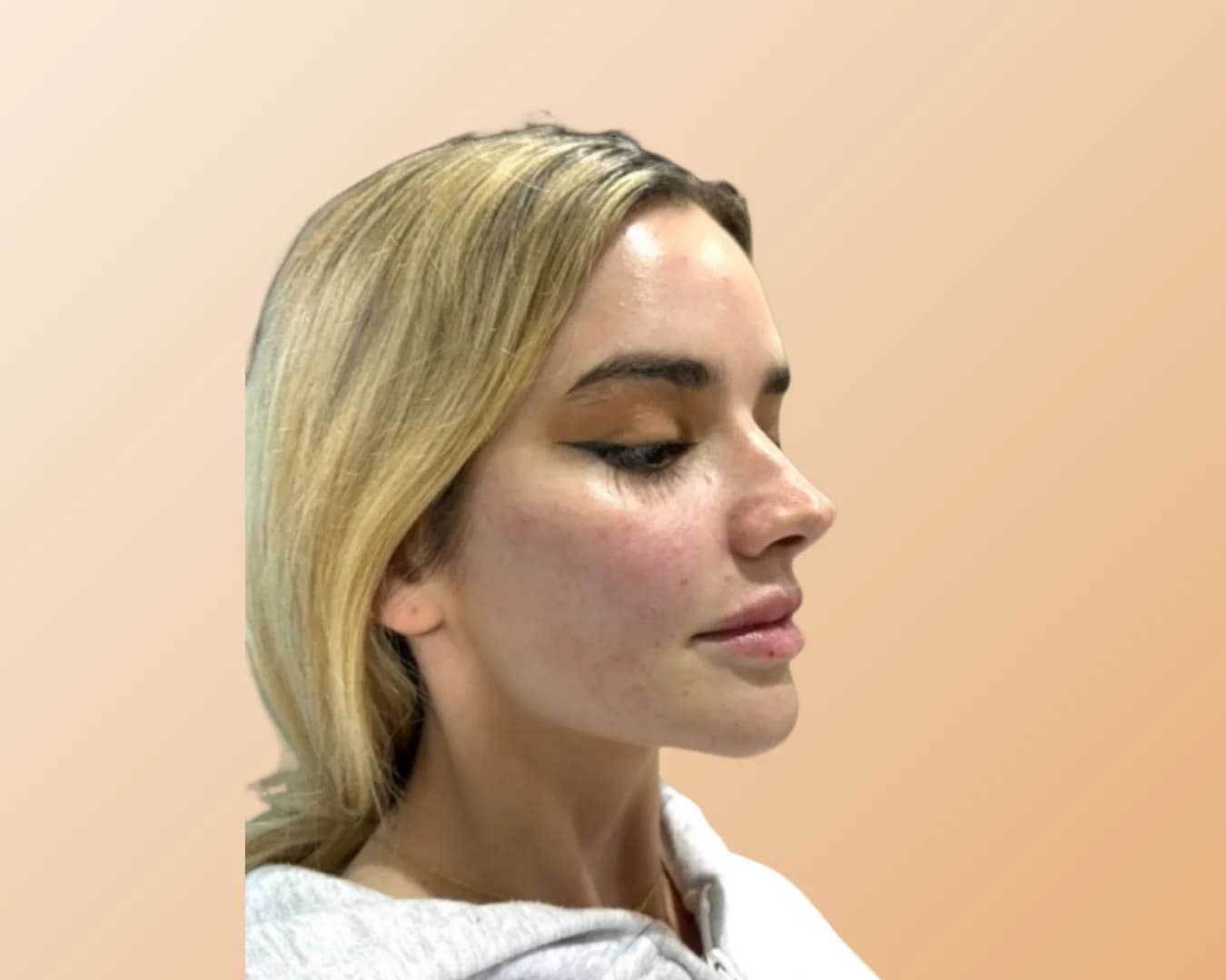 The same woman in the same three-quarter view after treatment, with the under-eye area looking fuller and brighter