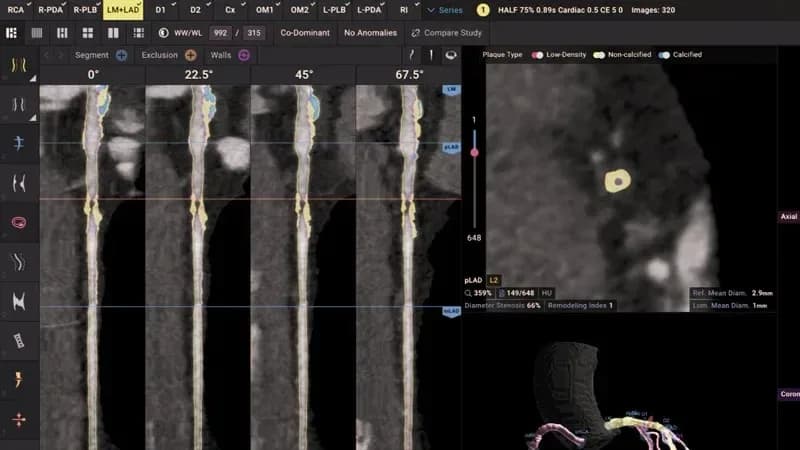 AI cardiac analysis software showing a coronary artery in four rotational views, with low-density, non-calcified and calcified plaque highlighted alongside stenosis and vessel diameter readings