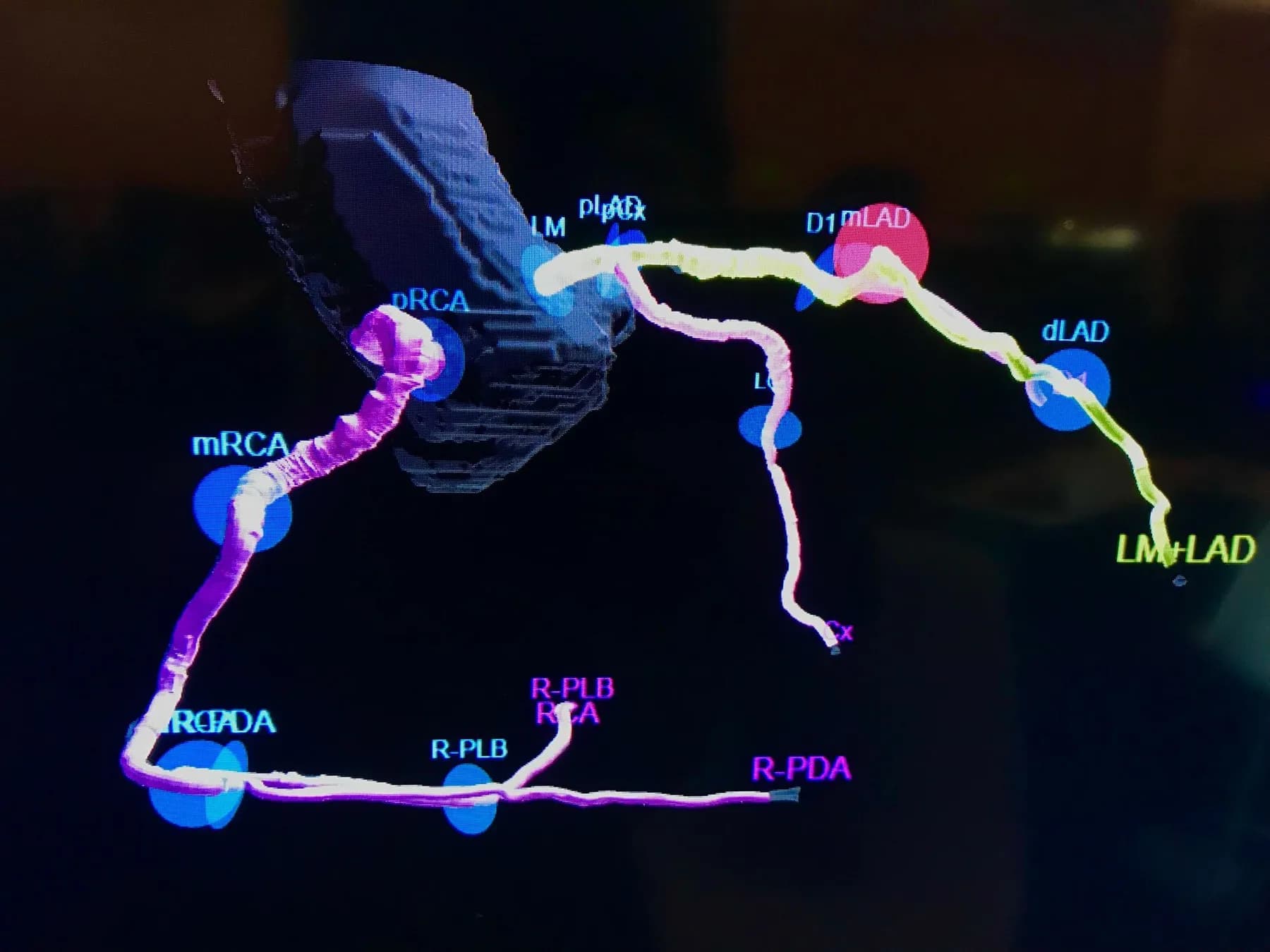 AI-labelled three-dimensional reconstruction of the coronary arteries, with each vessel segment individually named and highlighted in colour