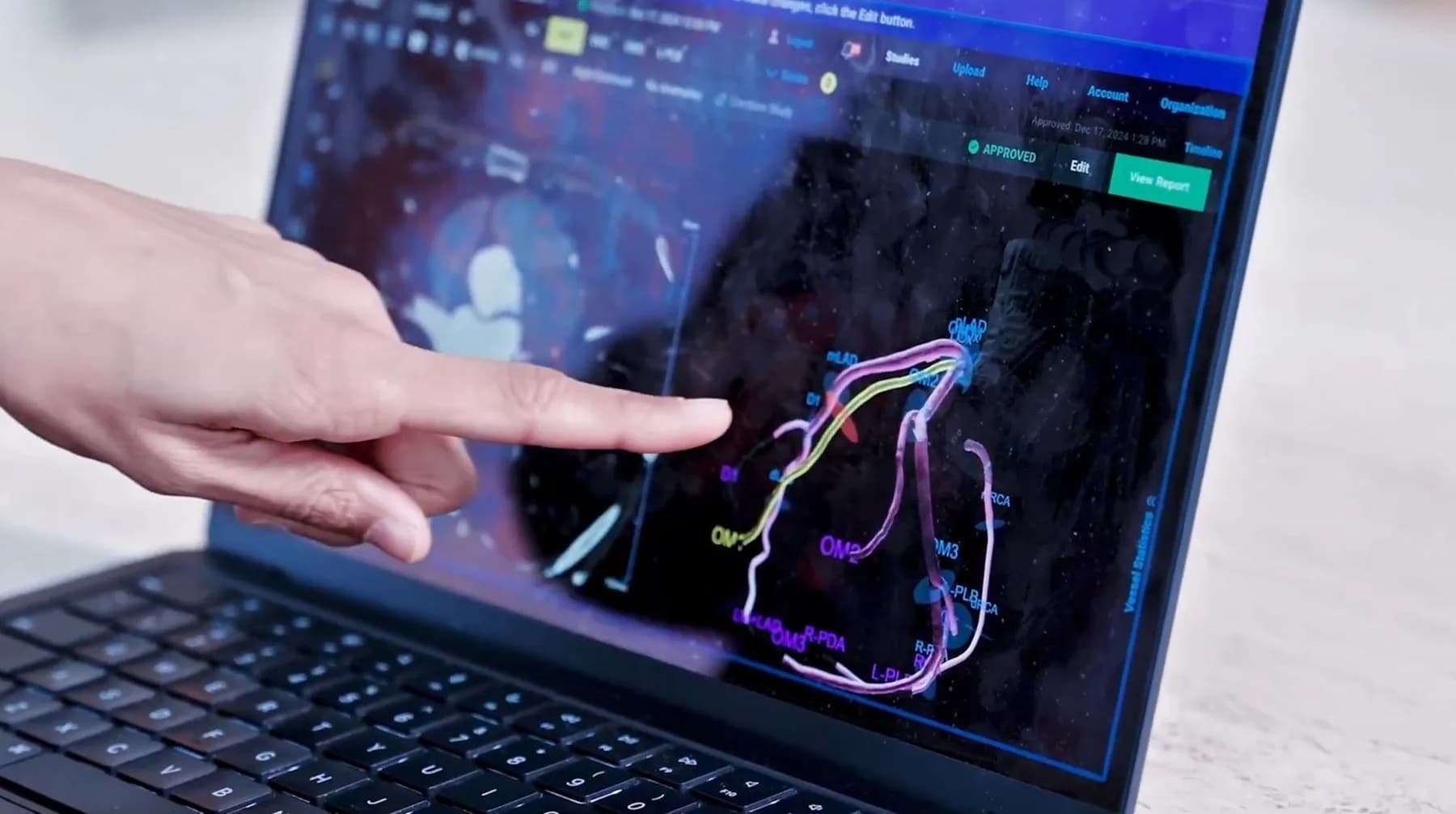 A clinician pointing to an AI-generated coronary artery map on a laptop screen